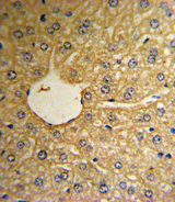 MSRA Antibody - Formalin-fixed and paraffin-embedded human hepatocarcinoma reacted with MSRA Antibody , which was peroxidase-conjugated to the secondary antibody, followed by DAB staining. This data demonstrates the use of this antibody for immunohistochemistry; clinical relevance has not been evaluated.