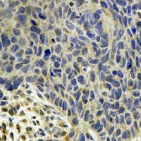 MSRB2 / MSRB Antibody - Immunohistochemical analysis of MsrB2 staining in human esophageal cancer formalin fixed paraffin embedded tissue section. The section was pre-treated using heat mediated antigen retrieval with sodium citrate buffer (pH 6.0). The section was then incubated with the antibody at room temperature and detected using an HRP conjugated compact polymer system. DAB was used as the chromogen. The section was then counterstained with hematoxylin and mounted with DPX.