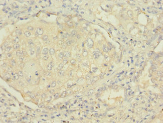 MSRB2 / MSRB Antibody - Immunohistochemistry of paraffin-embedded human lung cancer at dilution 1:100