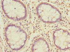 MSRB2 / MSRB Antibody - Immunohistochemistry of paraffin-embedded human colon cancer at dilution 1:100