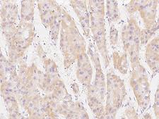MSRB2 / MSRB Antibody - Immunochemical staining of human MSRB2 in human hepatoma with rabbit polyclonal antibody at 1:200 dilution, formalin-fixed paraffin embedded sections.