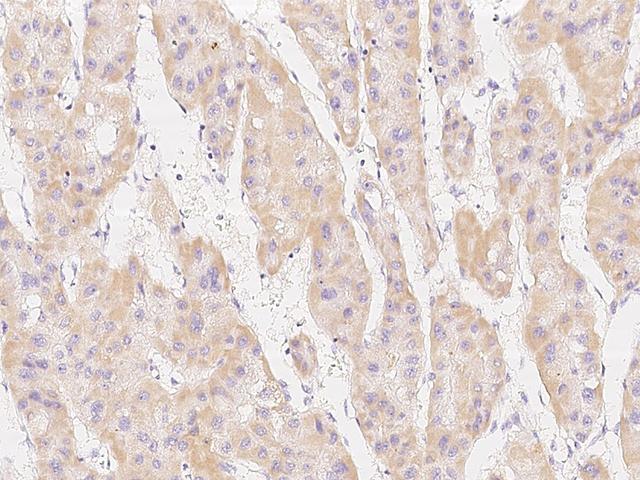 MSRB2 / MSRB Antibody - Immunochemical staining of human MSRB2 in human hepatoma with rabbit polyclonal antibody at 1:200 dilution, formalin-fixed paraffin embedded sections.