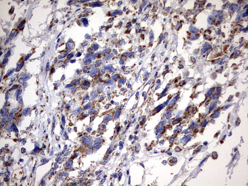MSRB3 Antibody - IHC of paraffin-embedded Adenocarcinoma of Human ovary tissue using anti-MSRB3 mouse monoclonal antibody. (Heat-induced epitope retrieval by 10mM citric buffer, pH6.0, 120°C for 3min).