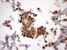 MST1 Antibody - Immunohistochemical staining of paraffin-embedded Carcinoma of Human lung tissue using anti-MST1 mouse monoclonal antibody. (Heat-induced epitope retrieval by Tris-EDTA, pH8.0)(1:150)