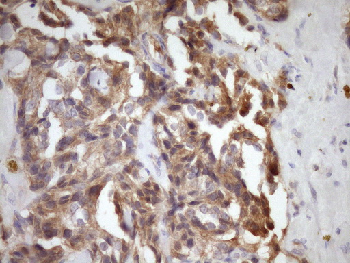 MST1 Antibody - Immunohistochemical staining of paraffin-embedded Adenocarcinoma of Human breast tissue using anti-MST1 mouse monoclonal antibody. (Heat-induced epitope retrieval by Tris-EDTA, pH8.0)(1:150)