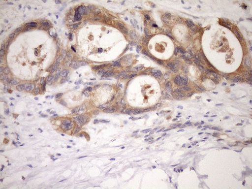 MST1 Antibody - Immunohistochemical staining of paraffin-embedded Adenocarcinoma of Human colon tissue using anti-MST1 mouse monoclonal antibody. (Heat-induced epitope retrieval by Tris-EDTA, pH8.0)(1:150)
