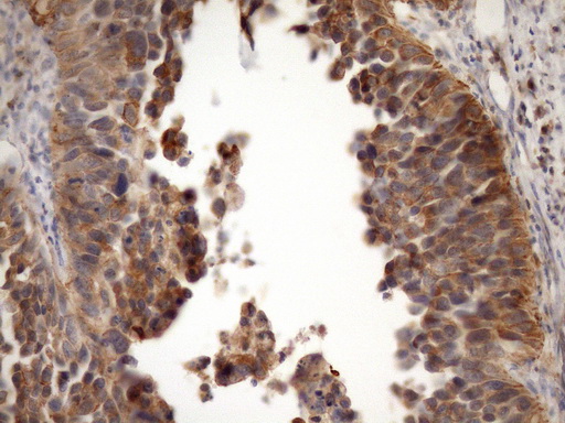 MST1 Antibody - Immunohistochemical staining of paraffin-embedded Carcinoma of Human kidney tissue using anti-MST1 mouse monoclonal antibody. (Heat-induced epitope retrieval by Tris-EDTA, pH8.0)(1:150)