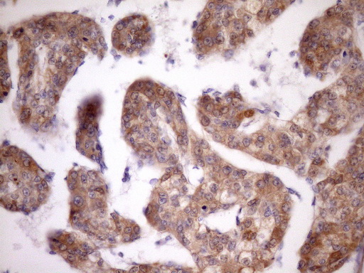MST1 Antibody - Immunohistochemical staining of paraffin-embedded Carcinoma of Human liver tissue using anti-MST1 mouse monoclonal antibody. (Heat-induced epitope retrieval by Tris-EDTA, pH8.0)(1:150)