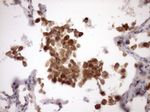 MST1 Antibody - IHC of paraffin-embedded Carcinoma of Human lung tissue using anti-MST1 mouse monoclonal antibody. (Heat-induced epitope retrieval by Tris-EDTA, pH8.0)(1:150).