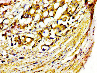 MST1 Antibody - Immunohistochemistry image at a dilution of 1:400 and staining in paraffin-embedded human gastric cancer performed on a Leica BondTM system. After dewaxing and hydration, antigen retrieval was mediated by high pressure in a citrate buffer (pH 6.0) . Section was blocked with 10% normal goat serum 30min at RT. Then primary antibody (1% BSA) was incubated at 4 °C overnight. The primary is detected by a biotinylated secondary antibody and visualized using an HRP conjugated SP system.