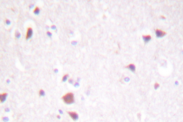 MST1 + MST2 Antibody - IHC of MST1/2 (M178) pAb in paraffin-embedded human breast carcinoma tissue.