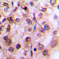 MST1 + MST2 Antibody - Immunohistochemical analysis of MST1/2 (pT183) staining in human breast cancer formalin fixed paraffin embedded tissue section. The section was pre-treated using heat mediated antigen retrieval with sodium citrate buffer (pH 6.0). The section was then incubated with the antibody at room temperature and detected using an HRP-conjugated compact polymer system. DAB was used as the chromogen. The section was then counterstained with hematoxylin and mounted with DPX.