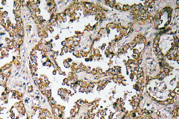 MSTN / GDF8 / Myostatin Antibody - IHC of GDF-8 (L38) pAb in paraffin-embedded human lung carcinoma tissue.