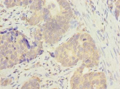 MSTO1 / MST Antibody - Immunohistochemistry of paraffin-embedded human gastric cancer using antibody at dilution of 1:100.