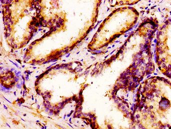 MSX1 Antibody - Immunohistochemistry image at a dilution of 1:300 and staining in paraffin-embedded human prostate cancer performed on a Leica BondTM system. After dewaxing and hydration, antigen retrieval was mediated by high pressure in a citrate buffer (pH 6.0) . Section was blocked with 10% normal goat serum 30min at RT. Then primary antibody (1% BSA) was incubated at 4 °C overnight. The primary is detected by a biotinylated secondary antibody and visualized using an HRP conjugated SP system.
