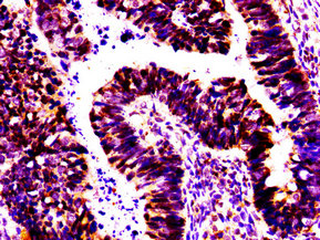 MSX2 / MSH Antibody - Immunohistochemistry image at a dilution of 1:100 and staining in paraffin-embedded human ovarian cancer performed on a Leica BondTM system. After dewaxing and hydration, antigen retrieval was mediated by high pressure in a citrate buffer (pH 6.0) . Section was blocked with 10% normal goat serum 30min at RT. Then primary antibody (1% BSA) was incubated at 4 °C overnight. The primary is detected by a biotinylated secondary antibody and visualized using an HRP conjugated SP system.