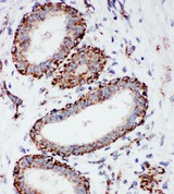 MT-CO1 / COX1 Antibody - MTCO1 antibody IHC-paraffin: Human Mammary Cancer Tissue.