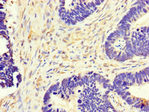 MT-CO1 / COX1 Antibody - Immunohistochemistry of paraffin-embedded human ovarian cancer at dilution of 1:100
