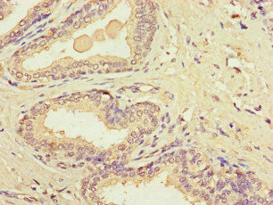 MT-CO1 / COX1 Antibody - Immunohistochemistry of paraffin-embedded human prostate cancer at dilution of 1:100
