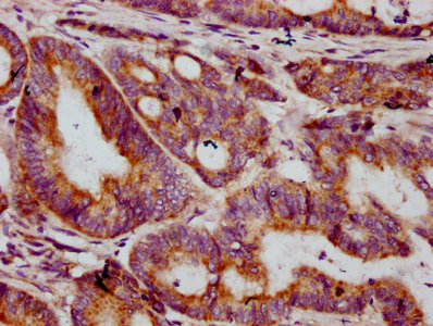 MT-CO2 Antibody - Immunohistochemistry Dilution at 1:400 and staining in paraffin-embedded human colon cancer performed on a Leica BondTM system. After dewaxing and hydration, antigen retrieval was mediated by high pressure in a citrate buffer (pH 6.0). Section was blocked with 10% normal Goat serum 30min at RT. Then primary antibody (1% BSA) was incubated at 4°C overnight. The primary is detected by a biotinylated Secondary antibody and visualized using an HRP conjugated SP system.