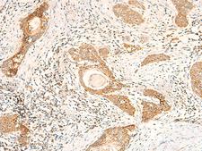 MT-CO2 Antibody - Immunohistochemistry of paraffin-embedded Human esophagus cancer tissue  using MT-CO2 Polyclonal Antibody at dilution of 1:60(×200)