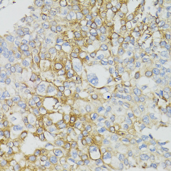 MT-ND5 Antibody - Immunohistochemistry of paraffin-embedded human prostate cancer tissue.