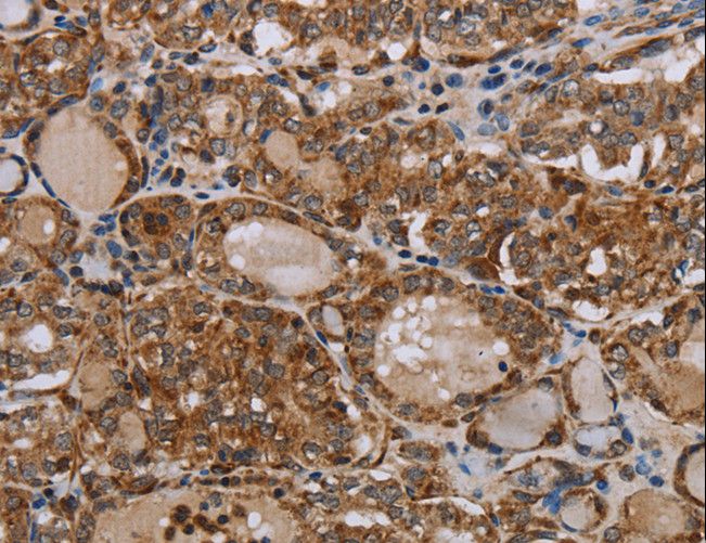 MT-ND6 Antibody - Immunohistochemistry of paraffin-embedded Human thyroid cancer using MT-ND6 Polyclonal Antibody at dilution of 1:40.