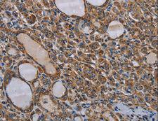 MT-ND6 Antibody - Immunohistochemistry of paraffin-embedded Human cervical cancer using MT-ND6 Polyclonal Antibody at dilution of 1:40.