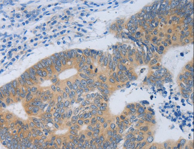 MT2A / Metallothionein 2A Antibody - Immunohistochemistry of paraffin-embedded Human colon cancer using MT2A Polyclonal Antibody at dilution of 1:40.