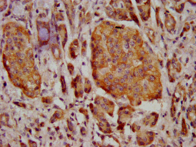 MT3 / Metallothionein 3 Antibody - IHC image of MT3 Antibody diluted at 1:400 and staining in paraffin-embedded human pancreatic cancer performed on a Leica BondTM system. After dewaxing and hydration, antigen retrieval was mediated by high pressure in a citrate buffer (pH 6.0). Section was blocked with 10% normal goat serum 30min at RT. Then primary antibody (1% BSA) was incubated at 4°C overnight. The primary is detected by a biotinylated secondary antibody and visualized using an HRP conjugated SP system.