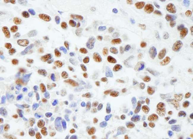 MTA1 Antibody - Detection of Human MTA1 by Immunohistochemistry. Sample: FFPE section of human non-small cell lung cancer. Antibody: Affinity purified rabbit anti-MTA1 used at a dilution of 1:1000 (0.2 ug/ml). Detection: DAB.
