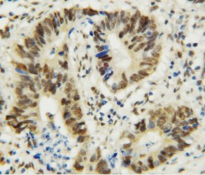 MTA1 Antibody - MTA1 antibody. IHC(P): Human Rectal Cancer Tissue.
