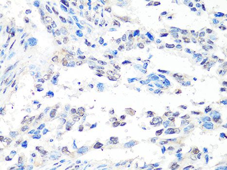 MTA2 Antibody - Immunohistochemistry of paraffin-embedded human lung cancer using MTA2 Antibody at dilution of 1:100 (40x lens).