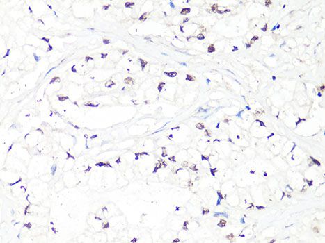 MTA2 Antibody - Immunohistochemistry of paraffin-embedded human gastric cancer using MTA2 Antibody at dilution of 1:100 (40x lens).