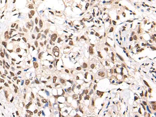 MTA2 Antibody - Immunohistochemistry of paraffin-embedded Human lung cancer tissue  using MTA2 Polyclonal Antibody at dilution of 1:40(×200)