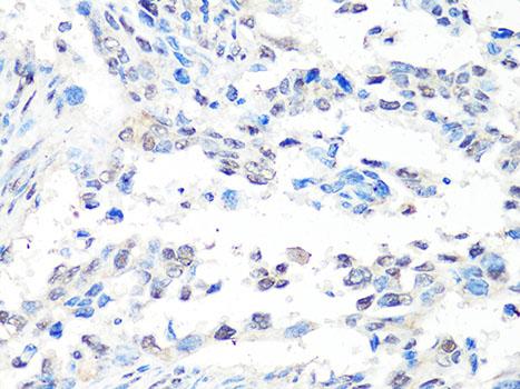MTA2 Antibody - Immunohistochemistry of paraffin-embedded Human lung cancer using MTA2 Polyclonal Antibody at dilution of 1:100 (40x lens).