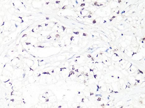 MTA2 Antibody - Immunohistochemistry of paraffin-embedded Human gastric cancer using MTA2 Polyclonal Antibody at dilution of 1:100 (40x lens).