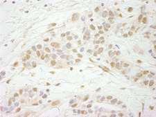 MTA3 Antibody - Detection of Human MTA3 by Immunohistochemistry. Sample: FFPE section of human breast carcinoma. Antibody: Affinity purified rabbit anti-MTA3 used at a dilution of 1:250.