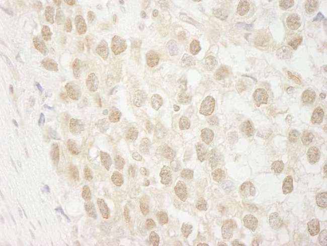 MTA3 Antibody - Detection of Human MTA3 by Immunohistochemistry. Sample: FFPE section of human seminoma. Antibody: Affinity purified rabbit anti-MTA3 used at a dilution of 1:250.