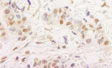 MTA3 Antibody - Detection of Human MTA3 by Immunohistochemistry. Sample: FFPE section of human breast carcinoma. Antibody: Affinity purified rabbit anti-MTA3 used at a dilution of 1:1000 (1 ug/ml). Detection: DAB.