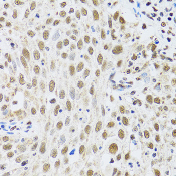 MTA3 Antibody - Immunohistochemistry of paraffin-embedded human lung cancer tissue.