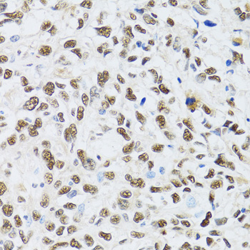 MTA3 Antibody - Immunohistochemistry of paraffin-embedded human liver cancer tissue.