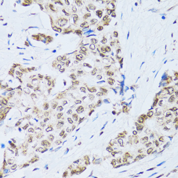 MTA3 Antibody - Immunohistochemistry of paraffin-embedded human breast cancer tissue.