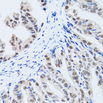 MTA3 Antibody - Immunohistochemistry of paraffin-embedded human gastric cancer tissue.