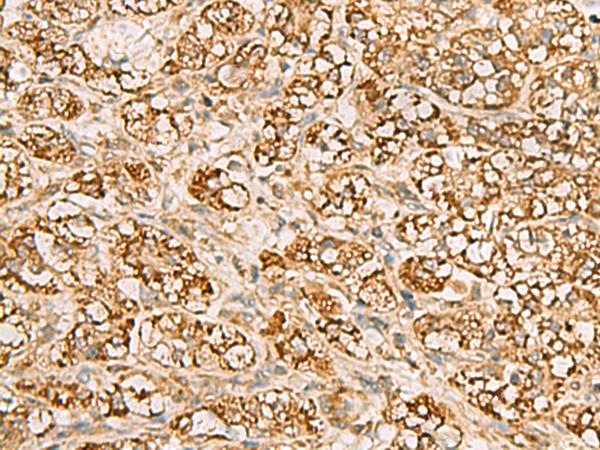 MTAP Antibody - Immunohistochemistry of paraffin-embedded Human liver cancer tissue  using MTAP Polyclonal Antibody at dilution of 1:70(×200)