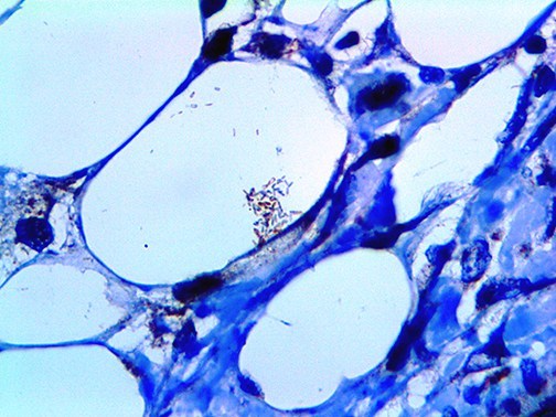 MTB / M. tuberculosis Antibody - HC of Myobacterium Tuberculosis on an FFPE Infected Lung Tissue