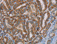 MTCH2 Antibody - Immunohistochemistry of paraffin-embedded Human thyroid cancer using MTCH2 Polyclonal Antibody at dilution of 1:45.