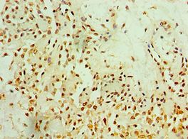 MTDH / Metadherin Antibody - Immunohistochemistry of paraffin-embedded human breast cancer using antibody at 1:100 dilution.