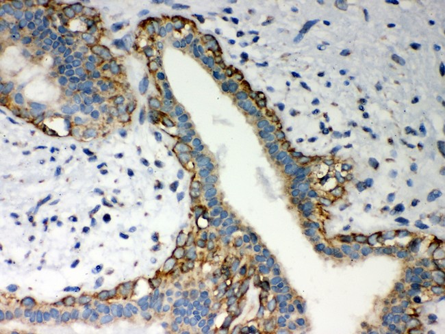 MTDH / Metadherin Antibody - LYRIC antibody IHC-paraffin: Human Mammary Cancer Tissue.