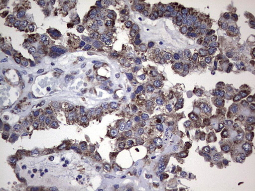 MTDH / Metadherin Antibody - Immunohistochemical staining of paraffin-embedded Adenocarcinoma of Human ovary tissue using anti-MTDH mouse monoclonal antibody. (Heat-induced epitope retrieval by 1 mM EDTA in 10mM Tris, pH8.5, 120C for 3min,